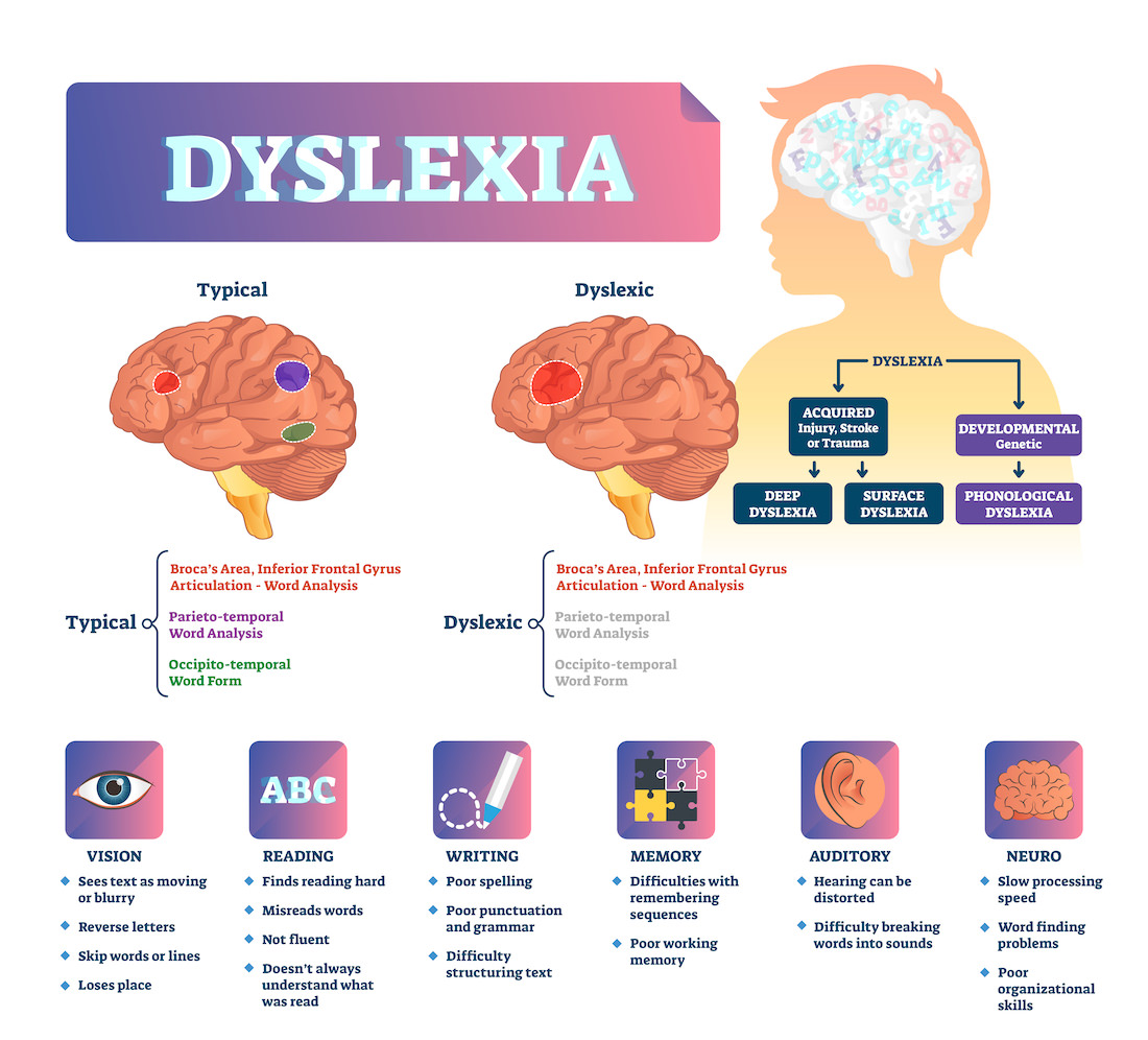 Dyslexia and the brain illustration chart
